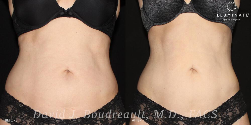 Liposuction Before & After Image