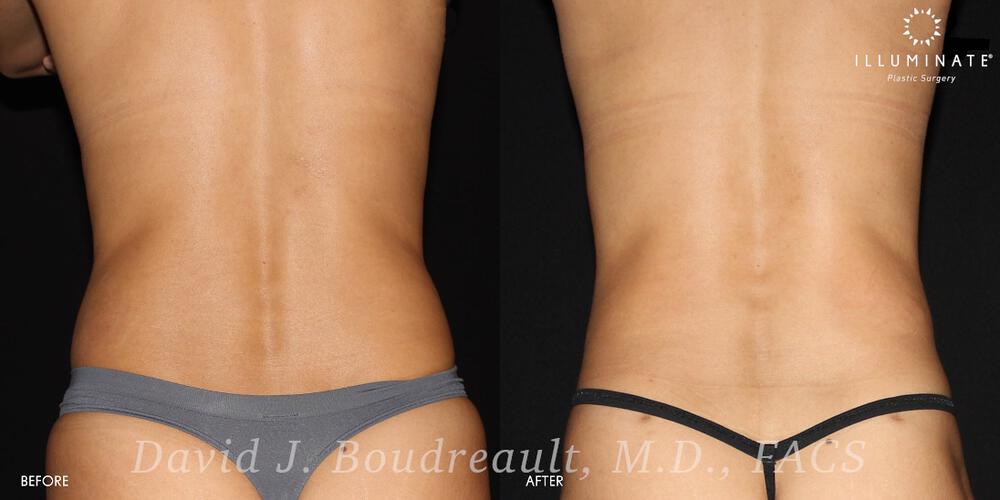 Liposuction Before & After Image