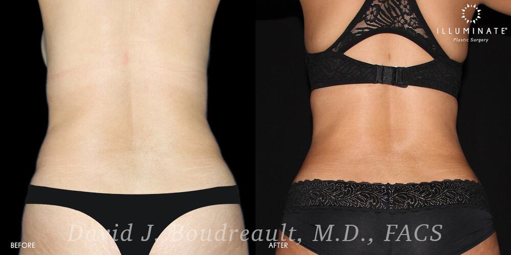 Liposuction Before & After Image