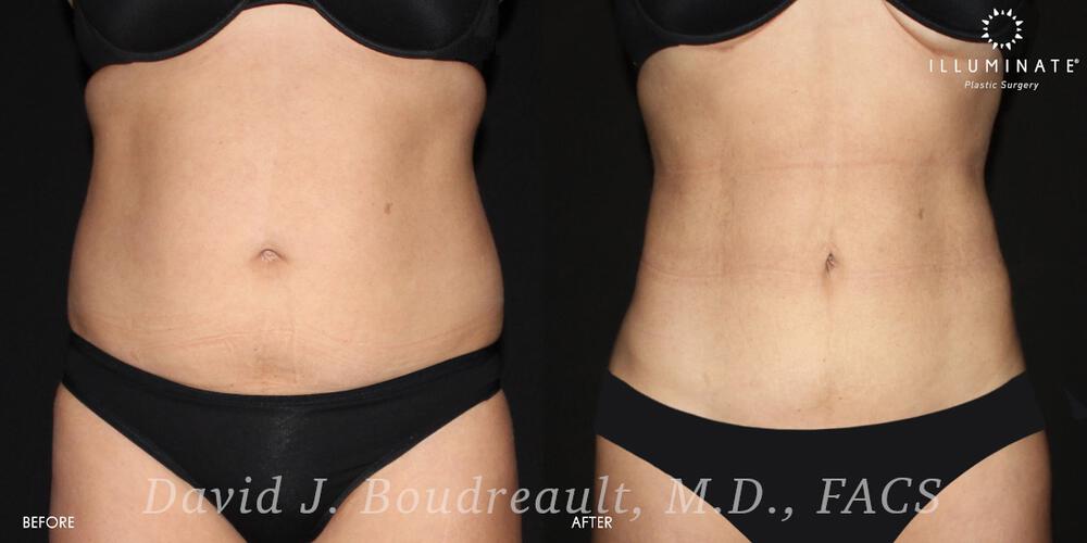 Liposuction Before & After Image