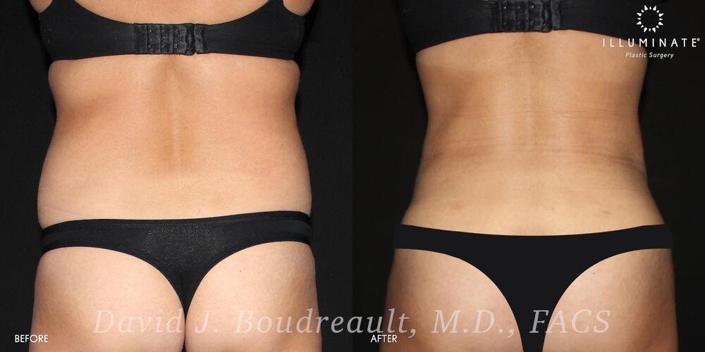 Liposuction Before & After Image