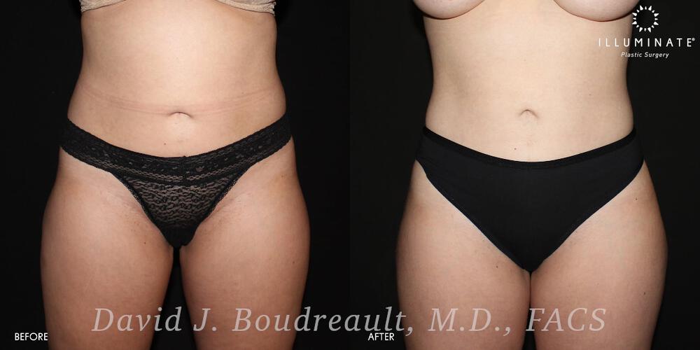 Liposuction Before & After Image