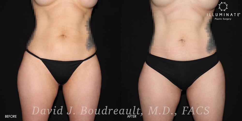 Liposuction Before & After Image