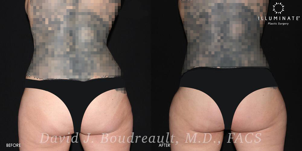 Liposuction Before & After Image