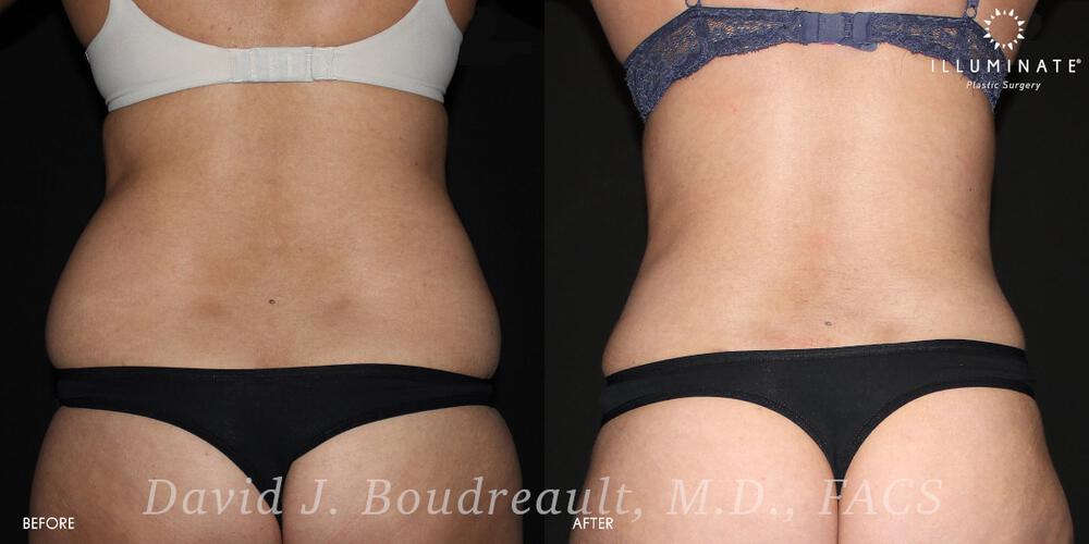 Liposuction Before & After Image