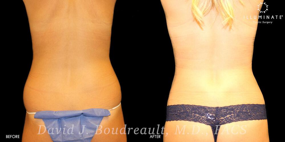 Liposuction Before & After Image