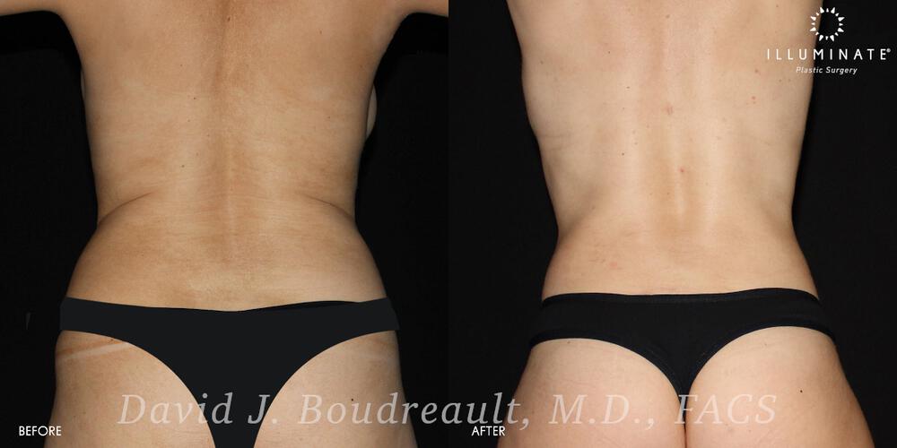 Liposuction Before & After Image