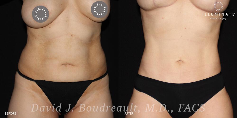 Liposuction Before & After Image