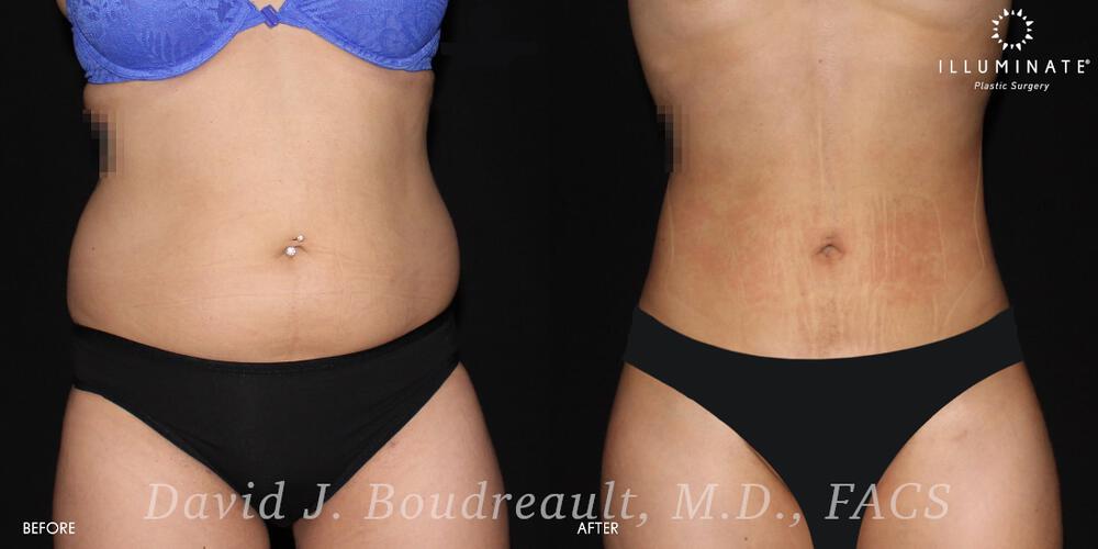 Liposuction Before & After Image