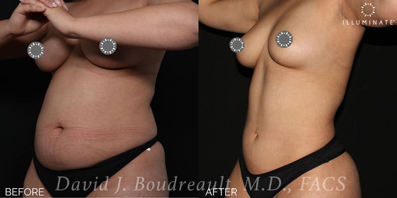 Liposuction Before & After Image