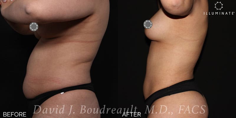 Liposuction Before & After Image