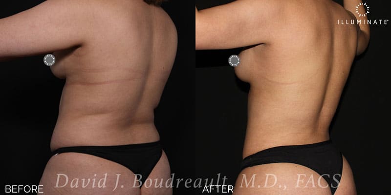 Liposuction Before & After Image