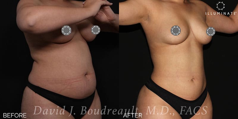 Liposuction Before & After Image