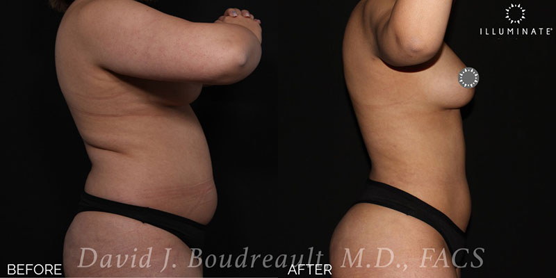 Liposuction Before & After Image