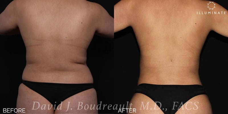 Liposuction Before & After Image