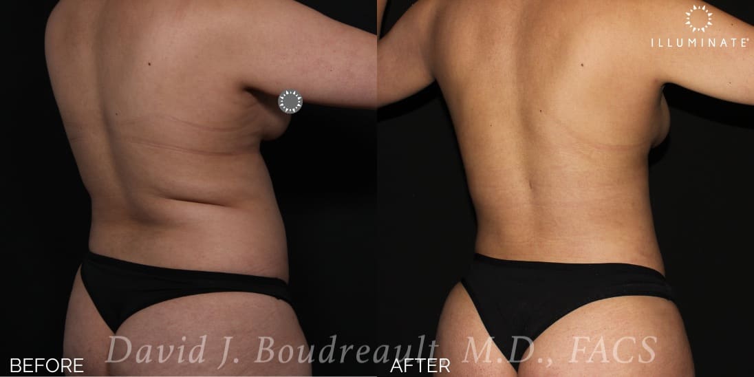 Liposuction Before & After Image