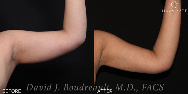 Liposuction Before & After Image