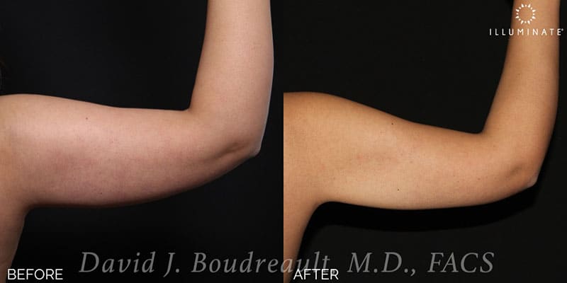 Liposuction Before & After Image