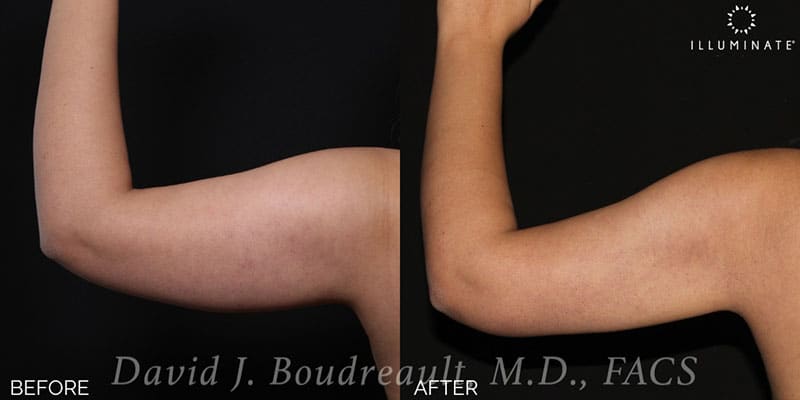 Liposuction Before & After Image