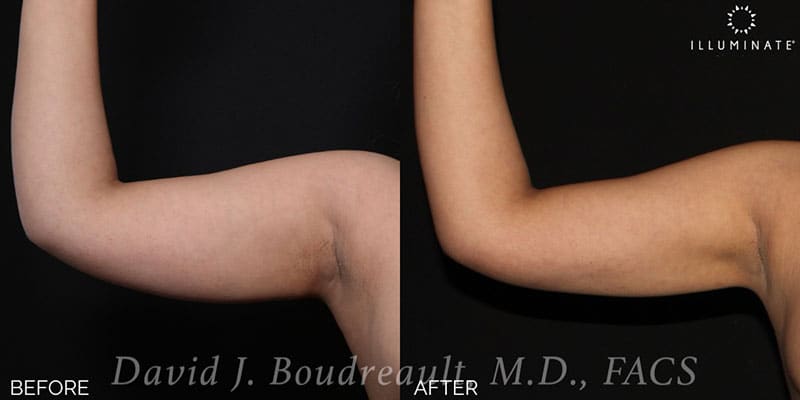 Liposuction Before & After Image