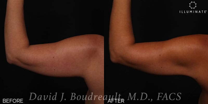 Liposuction Before & After Image