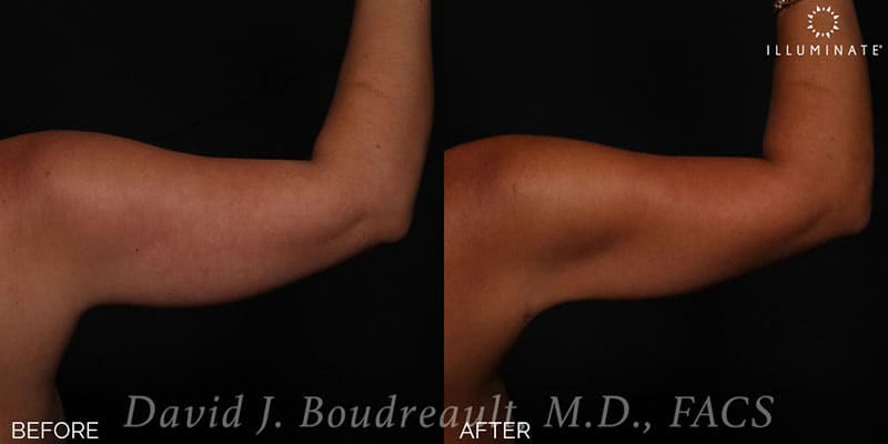 Liposuction Before & After Image