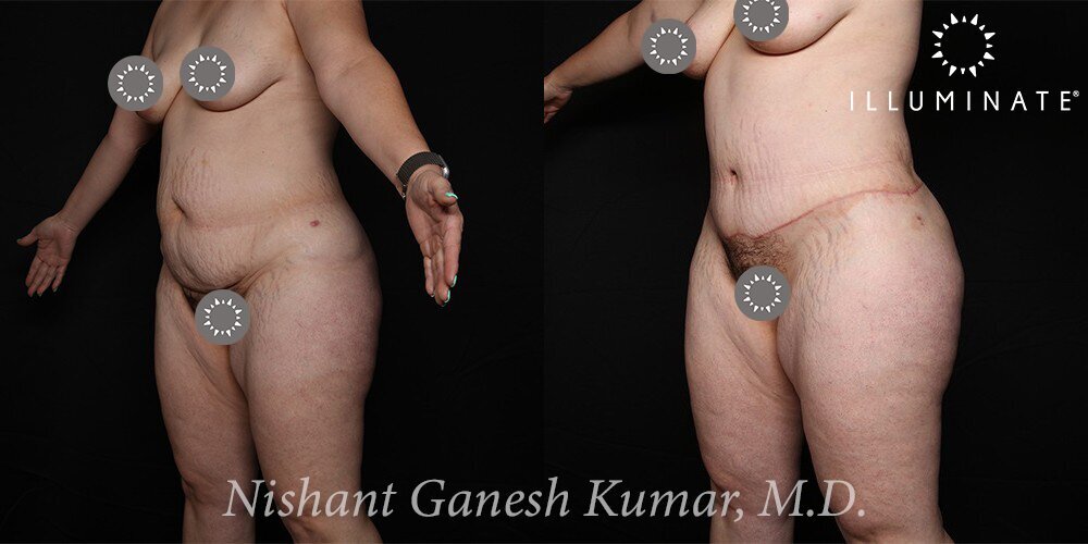 Liposuction Before & After Image