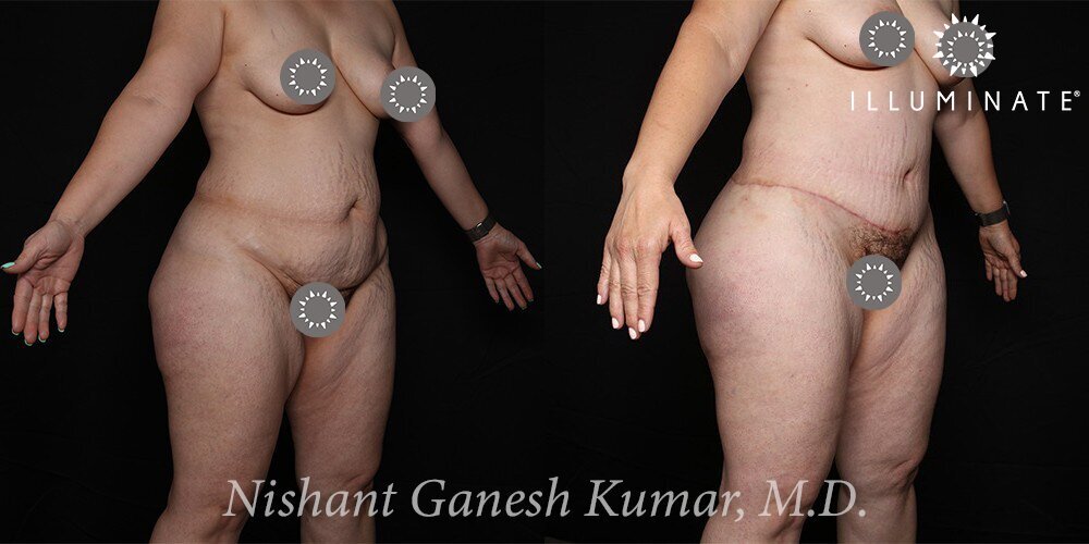 Liposuction Before & After Image