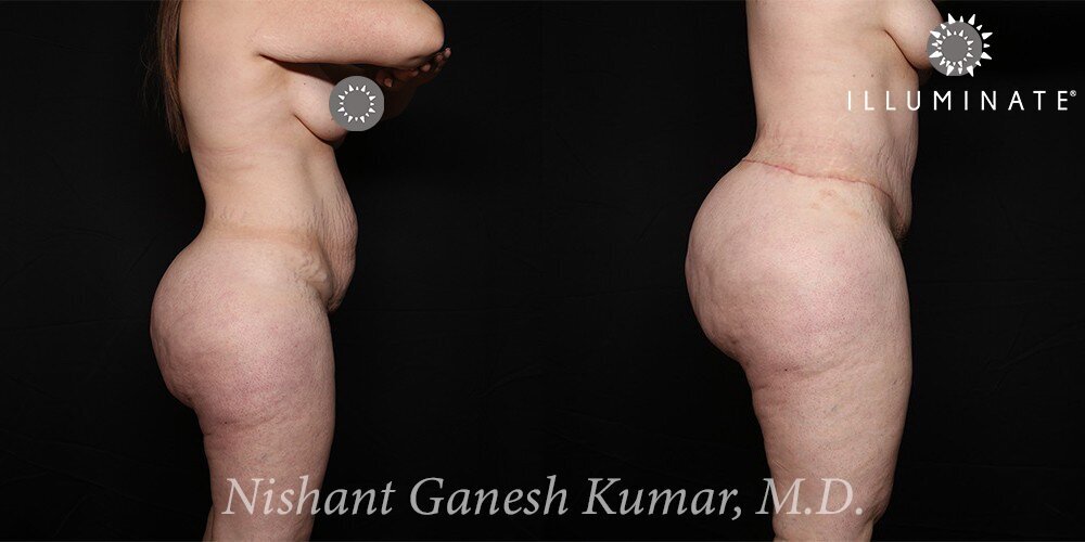 Liposuction Before & After Image