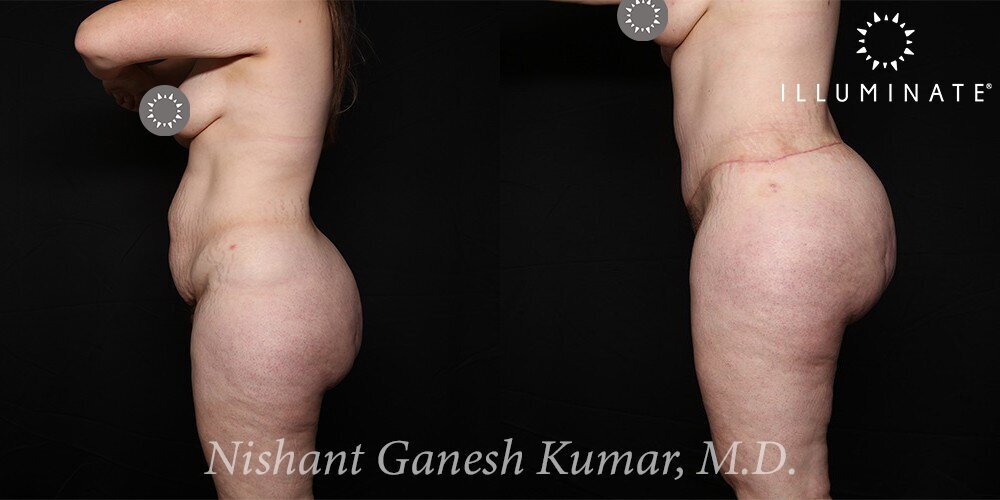 Liposuction Before & After Image
