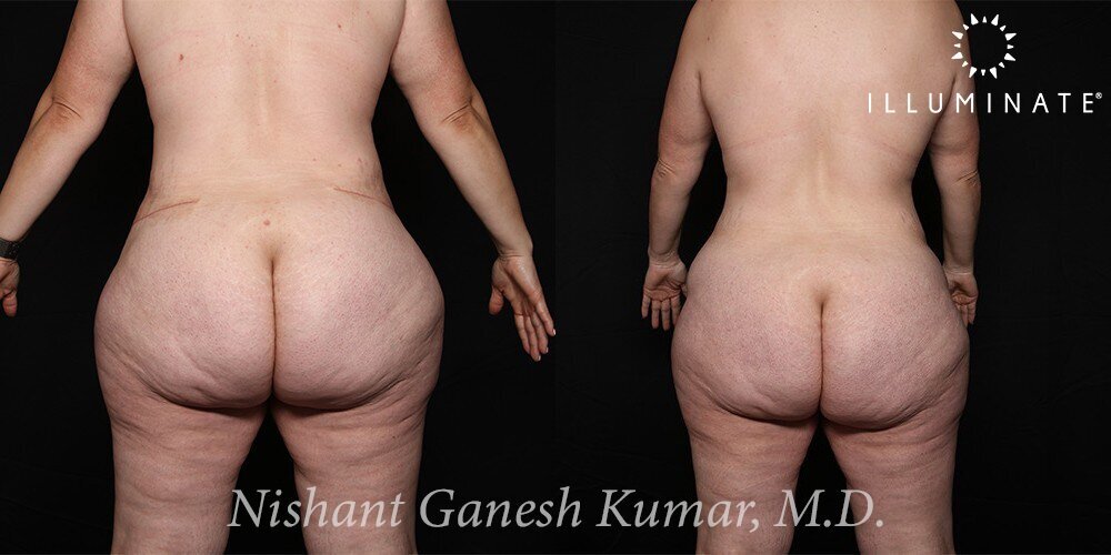 Liposuction Before & After Image