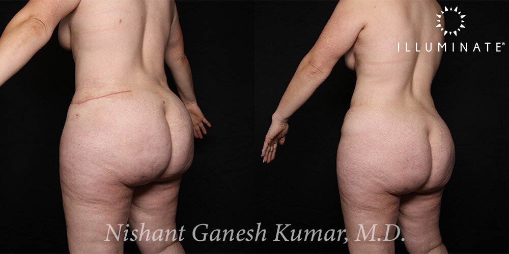 Liposuction Before & After Image