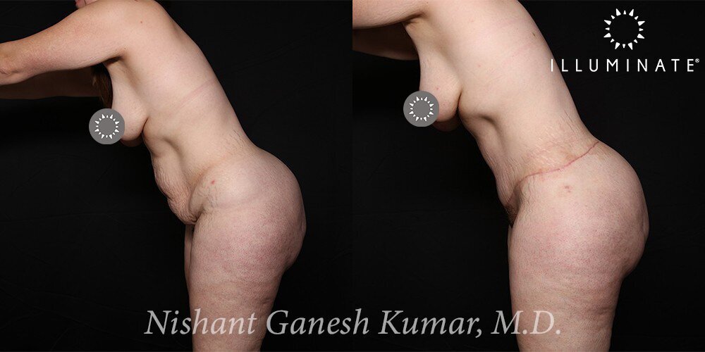 Liposuction Before & After Image