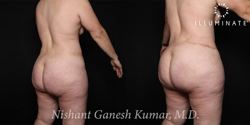 Liposuction Before & After Image