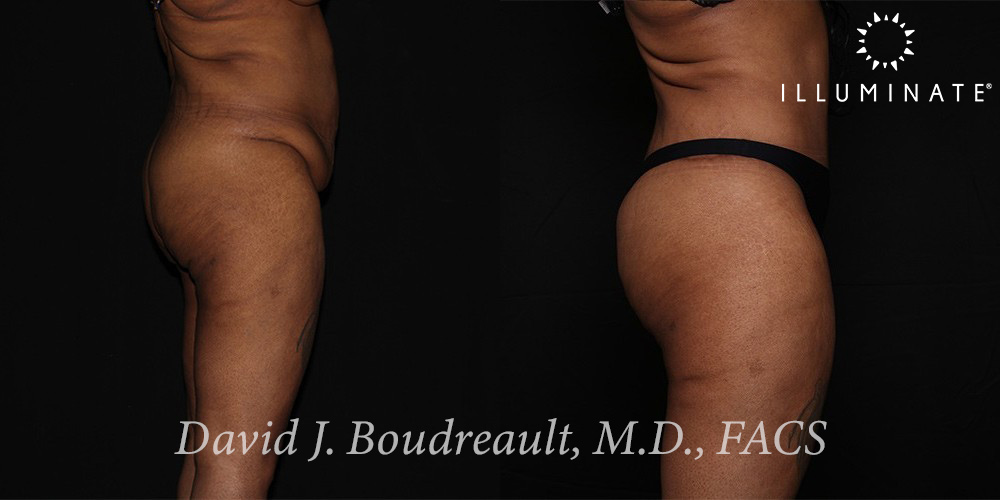 Liposuction Before & After Image
