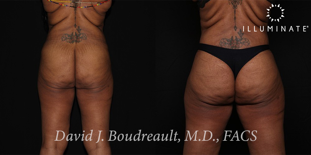 Liposuction Before & After Image