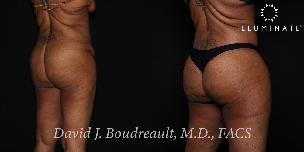 Liposuction Before & After Image