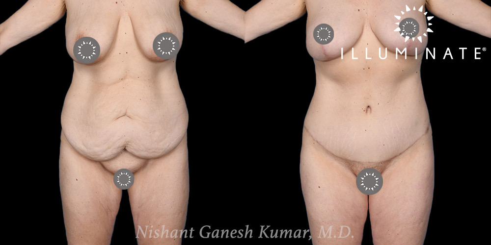 Mommy Makeover Before & After Image