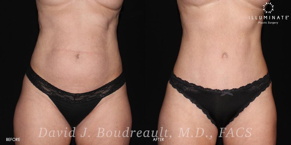 Tummy Tuck Before & After Image