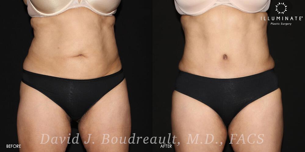 Tummy Tuck Before & After Image