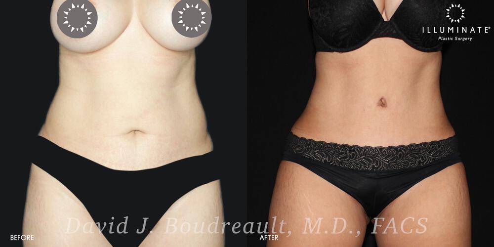 Tummy Tuck Before & After Image