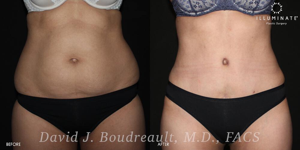 Tummy Tuck Before & After Image