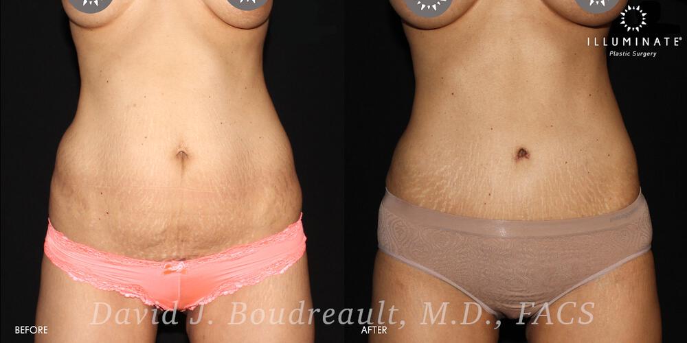 Tummy Tuck Before & After Image