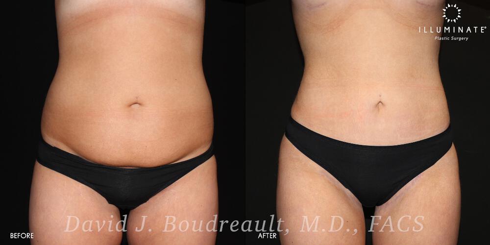 Tummy Tuck Before & After Image