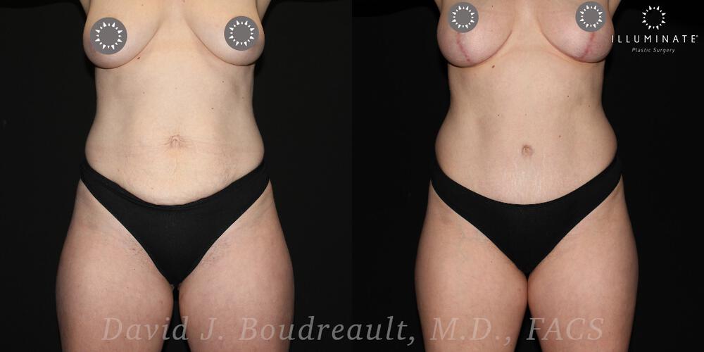 Tummy Tuck Before & After Image