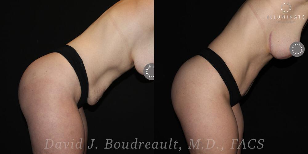 Tummy Tuck Before & After Image