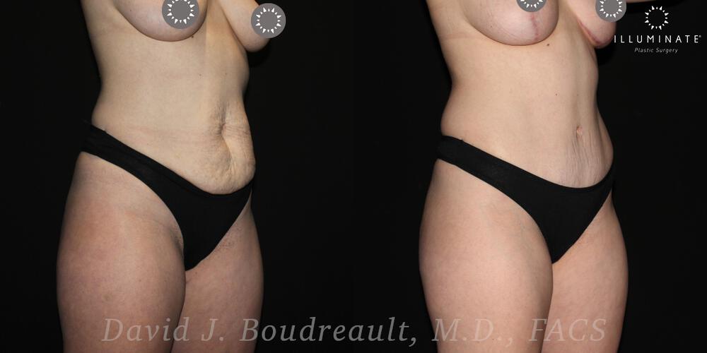 Tummy Tuck Before & After Image