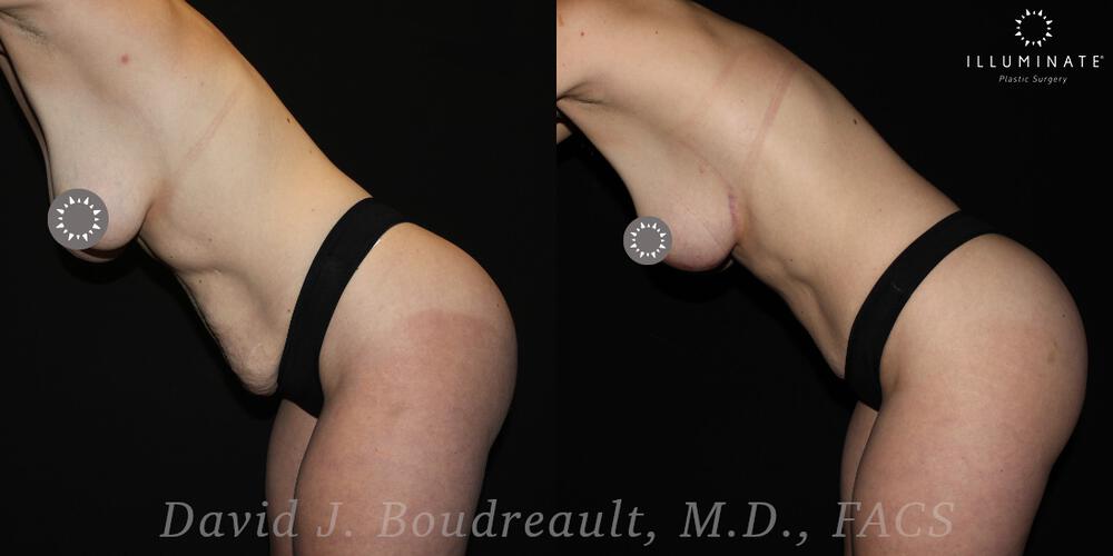 Tummy Tuck Before & After Image