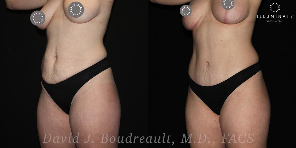 Tummy Tuck Before & After Image