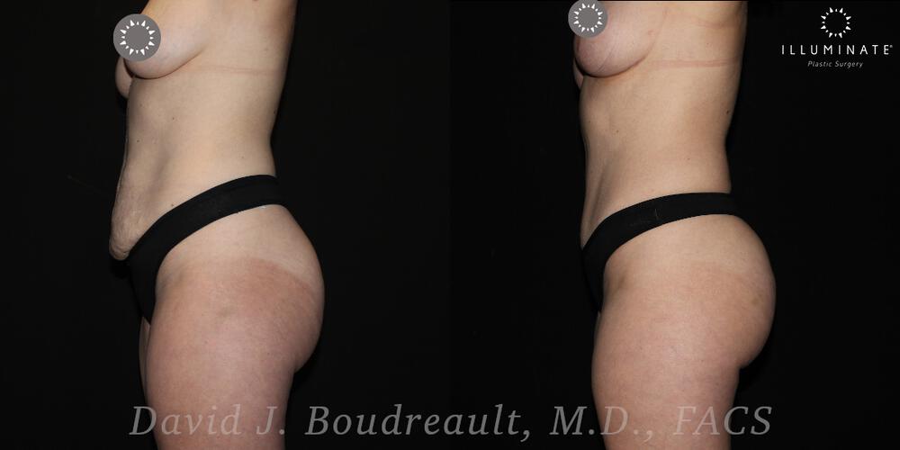 Tummy Tuck Before & After Image